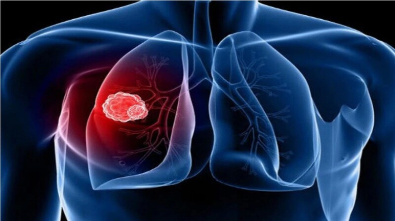 Vị trí và kích thước khối u phổi là hai yếu tố quan trọng để xác định tiên lượng bệnh nhân