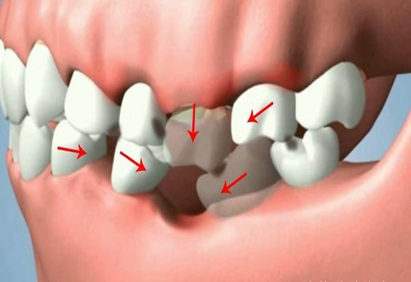 Thiếu răng số 6 có thể làm thay đổi cấu trúc của hàm