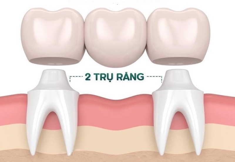 Cầu răng sứ không khả thi trong thay thế răng số 7 vì răng này thường nằm trong cùng của hàm
