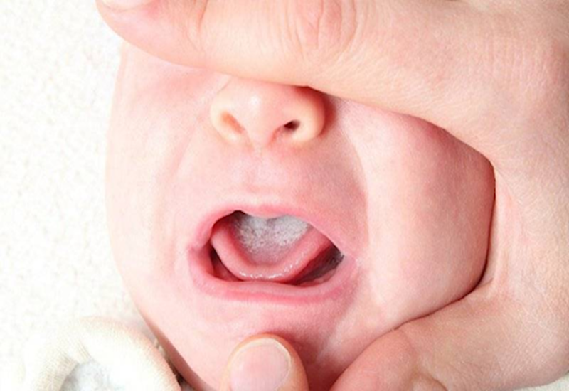 Không chỉ người lớn mà khoang miệng của trẻ sơ sinh cũng chứa nhiều vi khuẩn