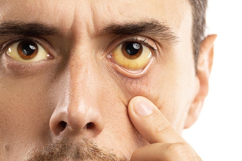 Vàng da, vàng mắt có thể là dấu hiệu cảnh báo sự xuất hiện của các bệnh lý về gan