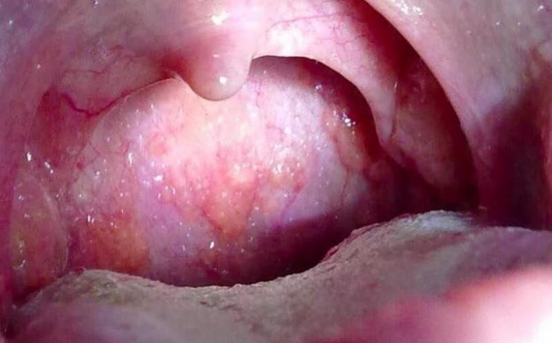 Viêm họng hạt là một loại u vòm họng lành tính