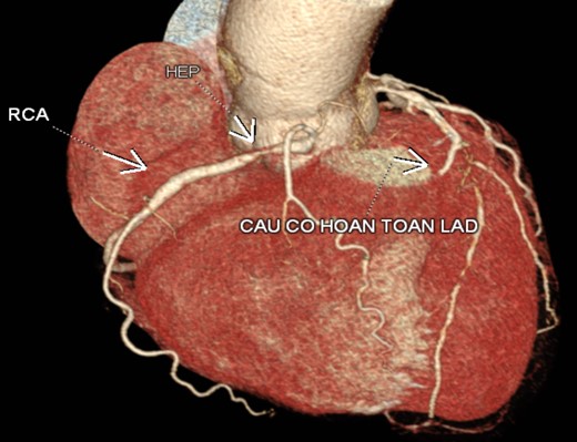 Hình ảnh chụp MSCT động mạch vành tại bệnh viện MEDLATEC
