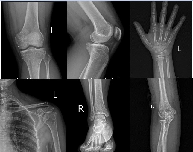 Hình ảnh chụp X-quang <a href='https://medlatec.vn/tin-tuc/can-benh-dau-nhuc-xuong-khop-o-nguoi-cao-tuoi-s68-n19513'  title ='xương khớp'>xương khớp</a> kỹ thuật số