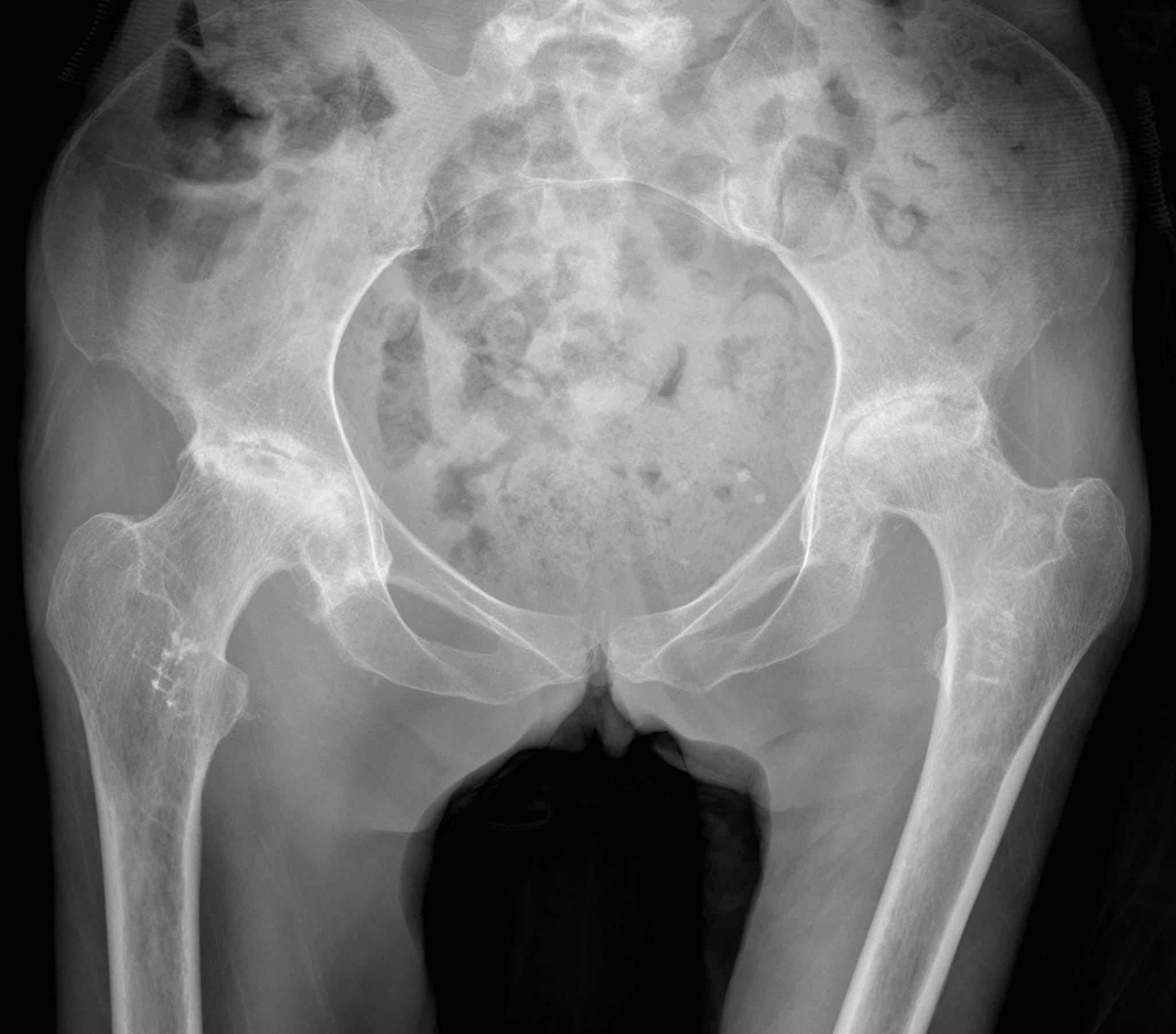 Hình ảnh X-quang hoại tử vô khuẩn chỏm xương đùi