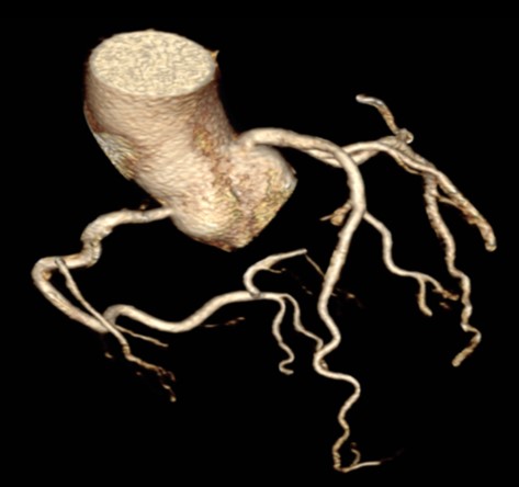 Hình ảnh chụp MSCT mạch vành