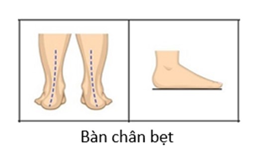 Hình ảnh minh họa bàn chân bẹt