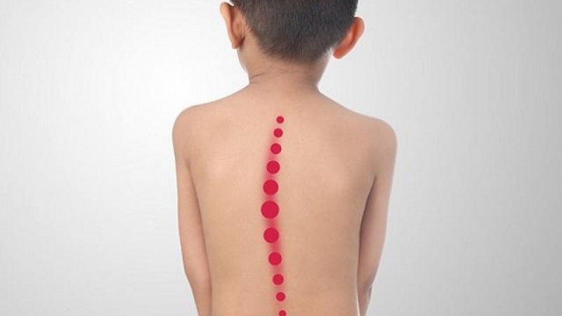Tình trạng lưng bị cong rất dễ gặp ở trẻ em