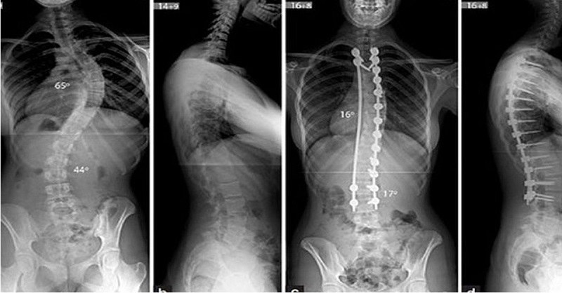 Hình ảnh chụp X-quang giúp phát hiện cột sống cong bất thường