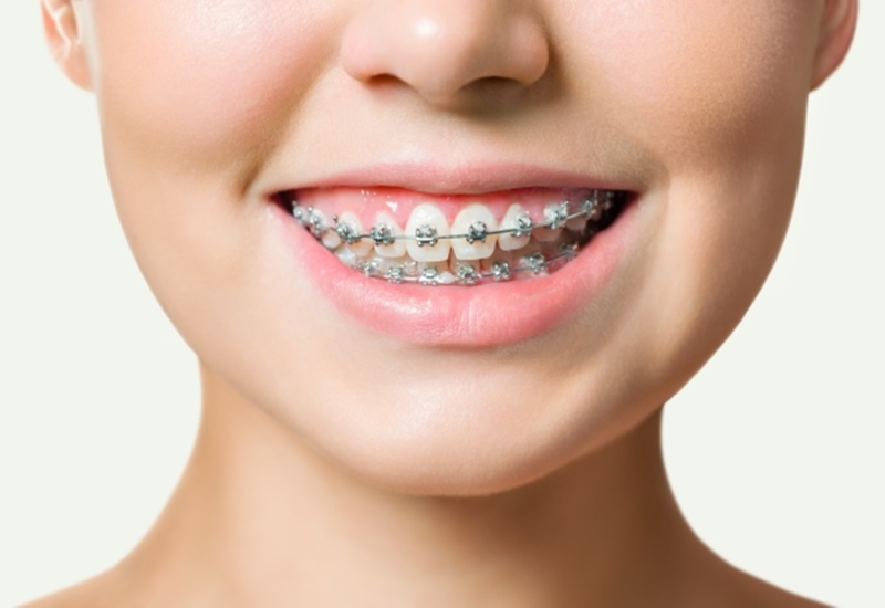 Niềng răng để khắc phục tình trạng răng cửa hở