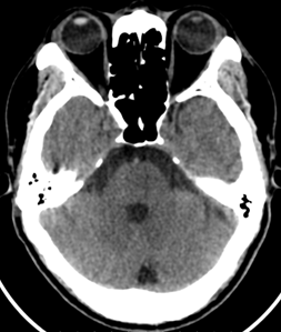 Hình ảnh chụp CT Sọ Não của bệnh nhân