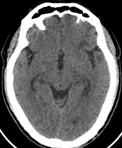 Hình ảnh chụp CT Sọ Não của bệnh nhân
