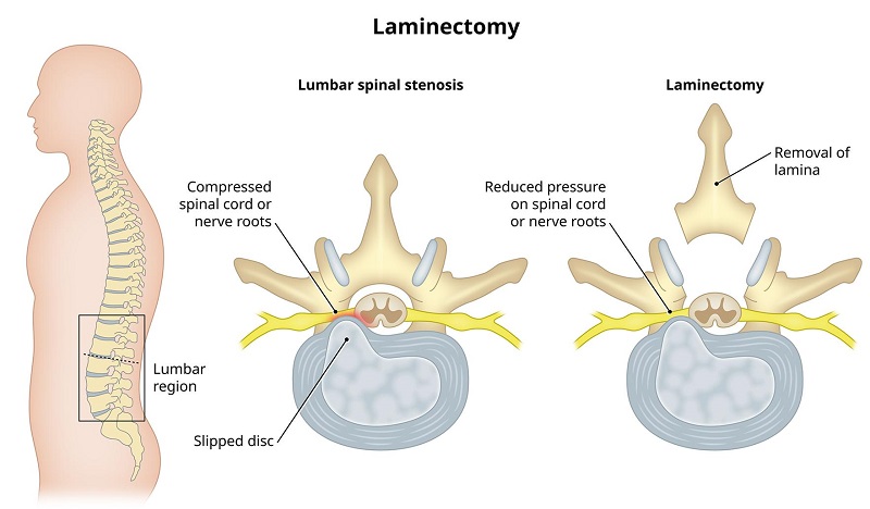 Laminectomy là phương pháp phẫu thuật mở ống sống để loại bỏ cơn đau do bệnh cột sống gây ra