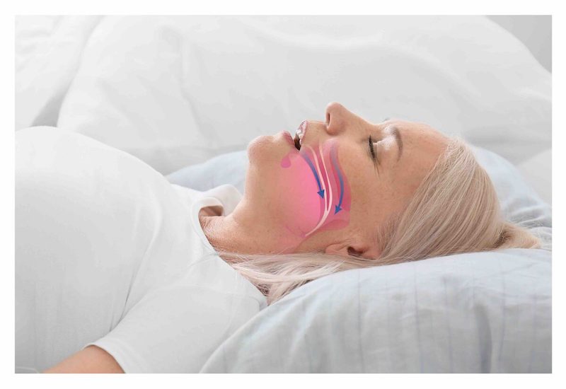 Ngưng thở khi ngủ là một hội chứng về đường hô hấp xảy ra trong khi ngủ