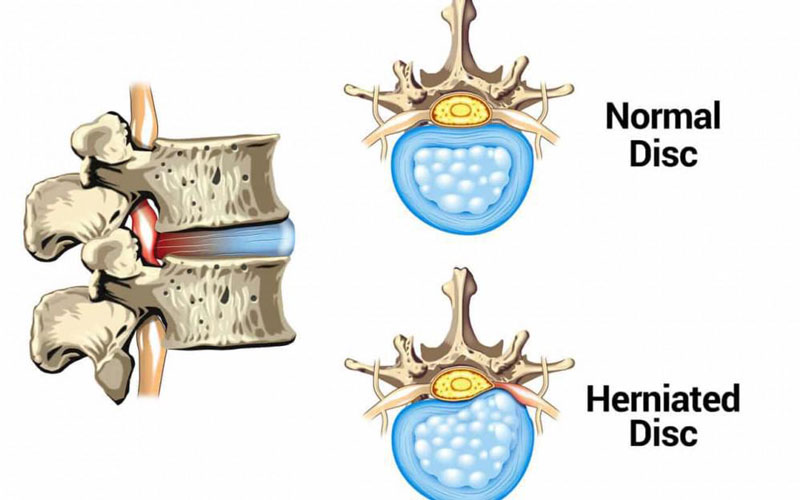 Thoát vị đĩa đệm là nguyên nhân khiến bệnh nhân bị đau thắt lưng