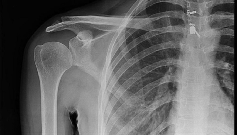 Chụp X-quang giúp phát hiện tổn thương do viêm chu vai