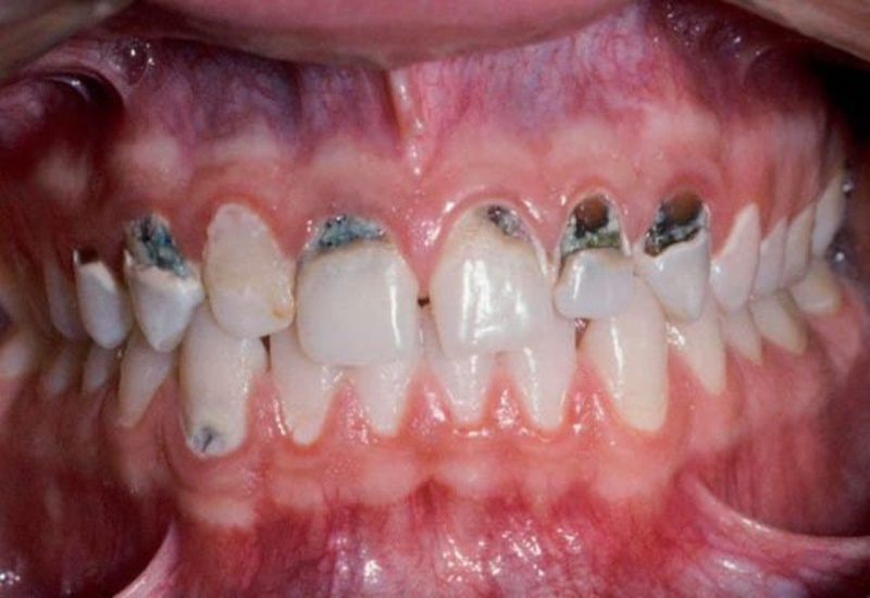 Răng đen khiến người bệnh tự ti khi giao tiếp