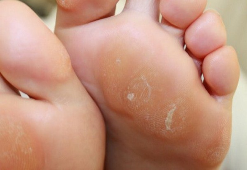 Chai chân thường không gây nguy hiểm đến sức khỏe