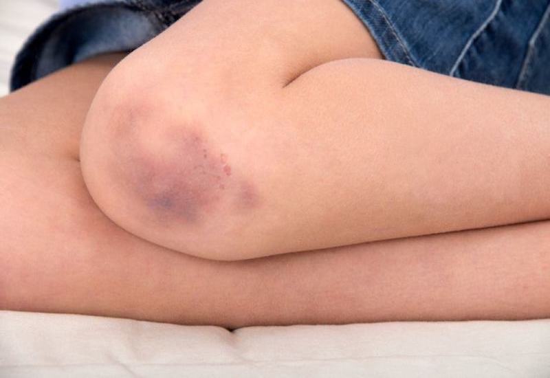 Triệu chứng tăng bạch cầu là trên da có vết bầm tím dù không bị va đập vào đâu