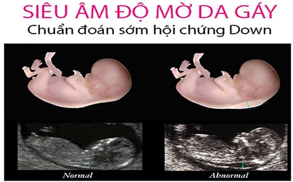 siêu âm thai trong 3 tháng đầu