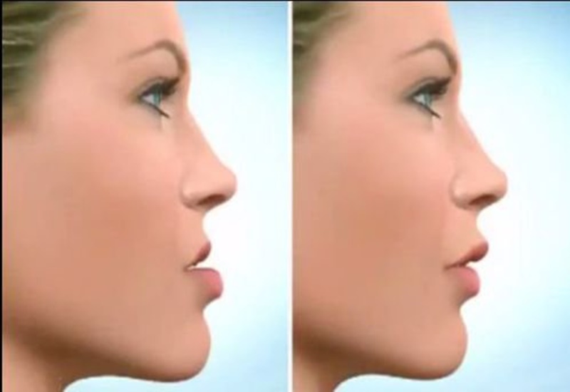Góc nghiêng của khuôn mặt cũng thay đổi sau niềng răng