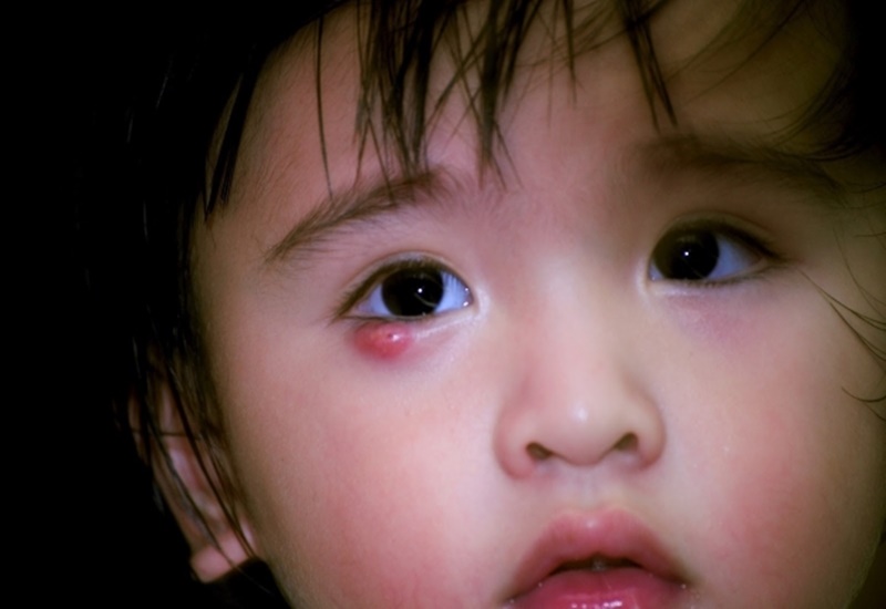 Chắp mắt có thể xảy ra ở trẻ nhỏ và người lớn