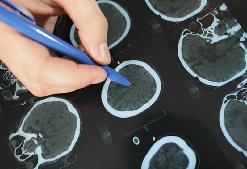 Chẩn đoán chết não bằng các biện pháp cận lâm sàng