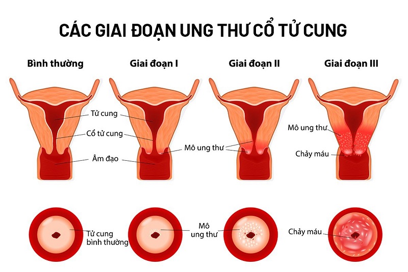 Hình minh họa các giai đoạn tiến triển của ung thư cổ tử cung