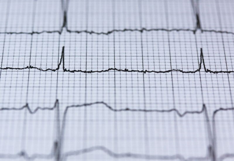 Điện tâm đồ hỗ trợ các bác sĩ trong chẩn đoán các bệnh về tim mạch
