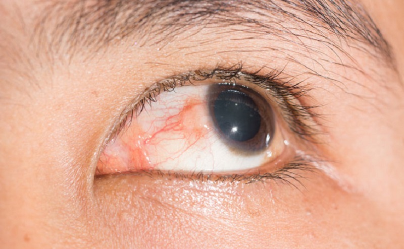 Xuất huyết mắt là tình trạng vỡ mạch máu nhỏ dưới củng mạc 