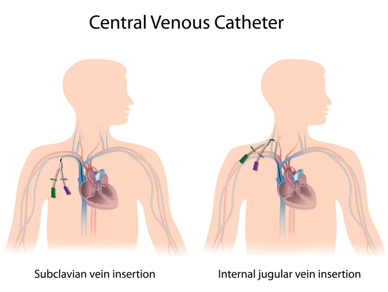Khi cần truyền dinh dưỡng cho bệnh nhân, bác sĩ sẽ sử dụng phương pháp đặt catheter tĩnh mạch