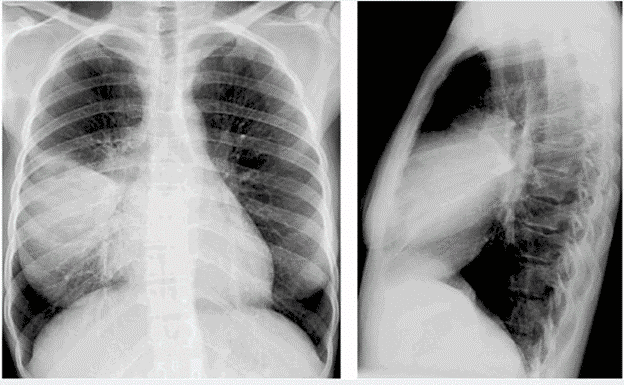 chụp x quang phổi