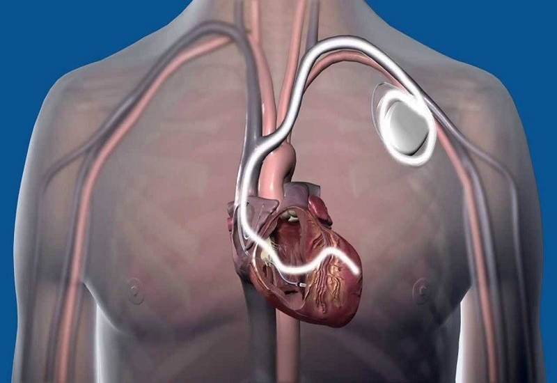 Dùng máy khử rung tim để phòng tránh biến chứng bệnh