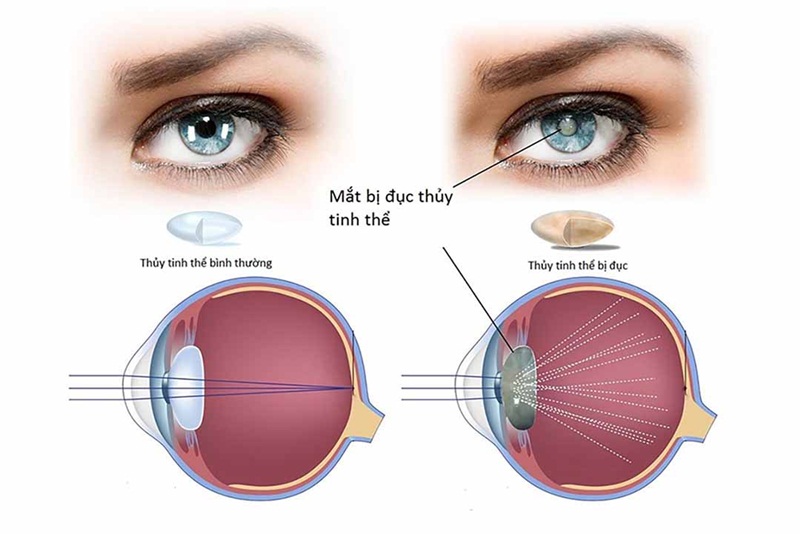Nhức mỏi mắt kéo dài là một trong các dấu hiệu đục thủy tinh thể