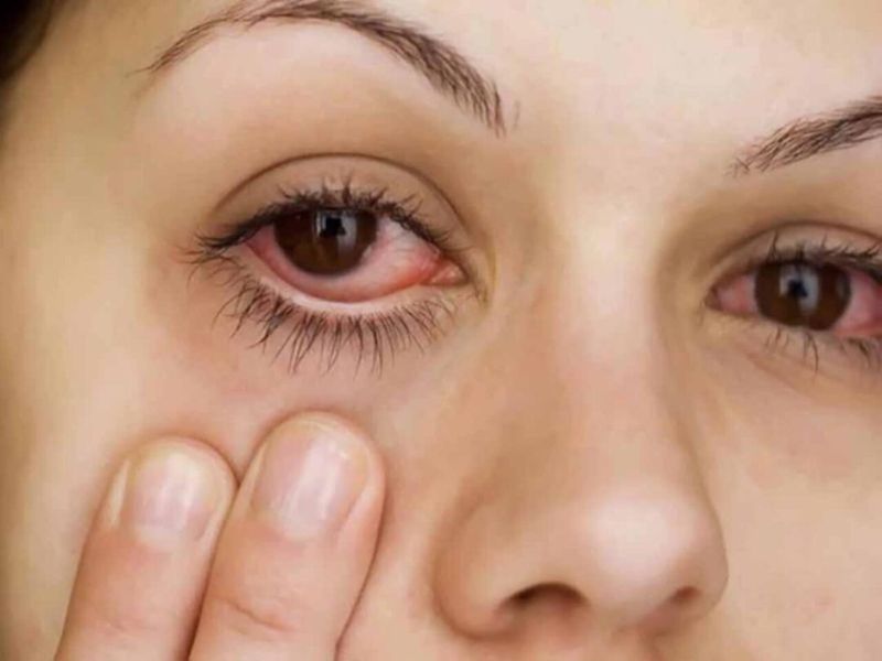 Tìm cách chữa trị ngay khi có triệu chứng mắt nổi cộm