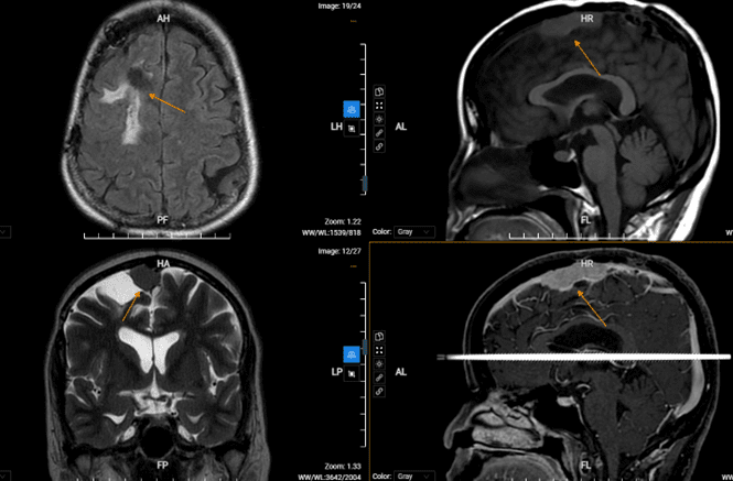 chụp cộng hưởng từ trong chẩn đoán u màng não