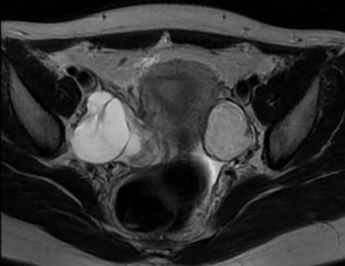 MRI tiểu khung có tiêm trong chẩn đoán u nang bì buồng trứng
