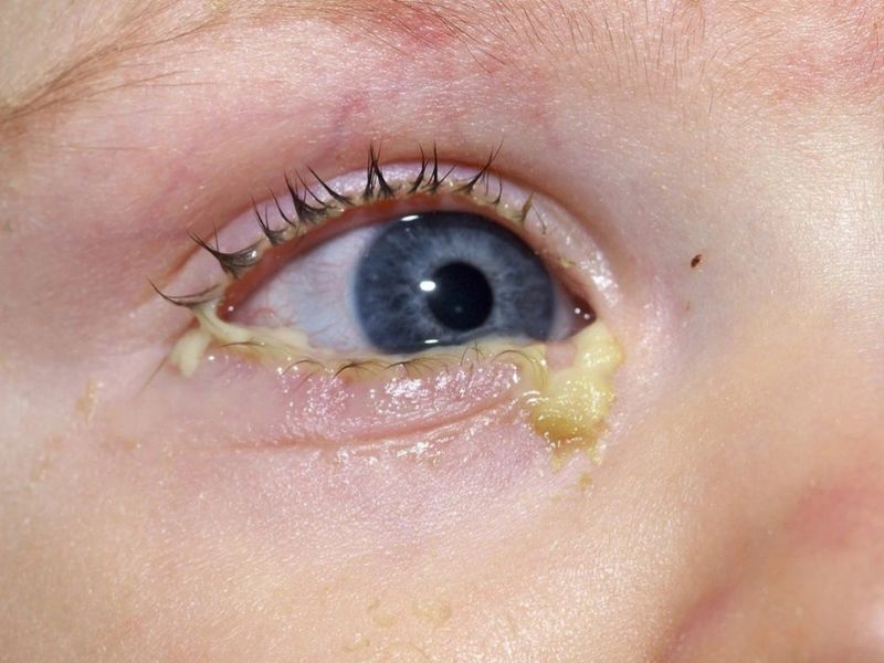 Mắt trẻ sơ sinh bị ghèn là trạng thái sinh lý bình thường