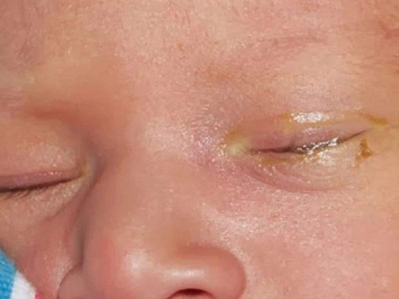 Biểu hiện màu sắc ghèn phản ánh tình trạng sức khỏe mắt ở bé