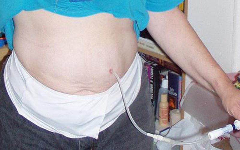 Người bệnh không bị phụ thuộc vào thiết bị, máy móc khi lọc màng bụng