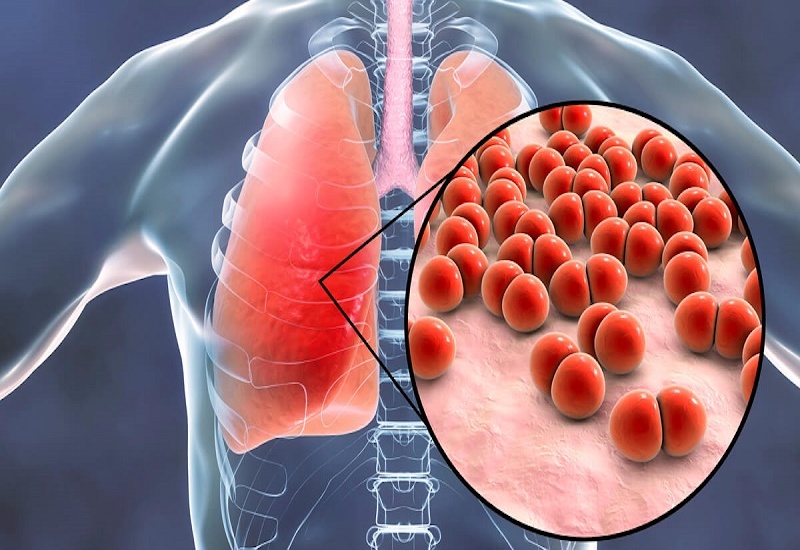 3 loại nấm Candida, Aspergillus và Cryptococcus là nguyên nhân phổ biến gây nấm phổi