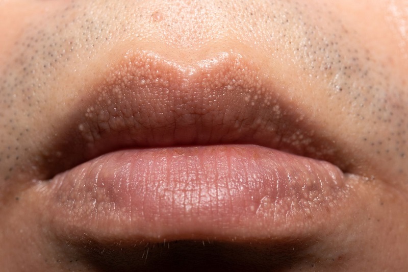 Chú ý biểu hiện bất thường đi kèm với tình trạng nổi hạt trắng nhỏ trên môi