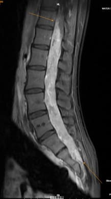 Chụp MRI trong chẩn đoán u tủy sống