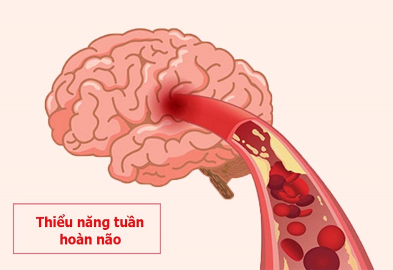 Thiểu năng tuần hoàn não có thể do hẹp động mạch đốt sống