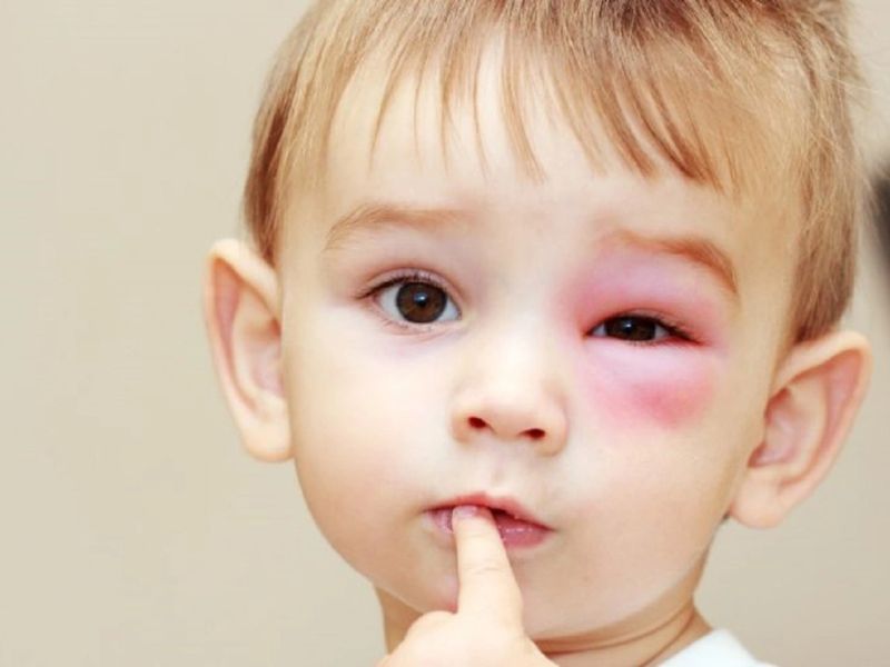 Nắm bắt nguyên nhân gây ra tình trạng sưng mắt ở bé 