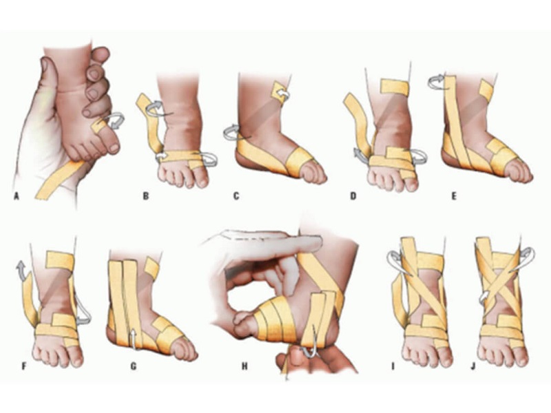 Bàn chân vẹo trong có thể được chữa khỏi bằng phương pháp vật lý trị liệu đơn giản