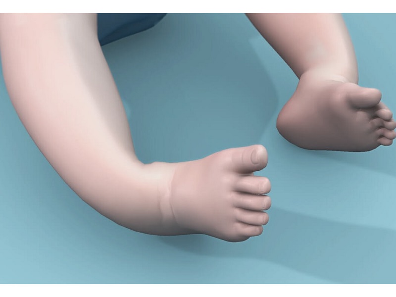 Khoèo chân ở trẻ là dạng dị tật bàn chân nặng và khá phức tạp
