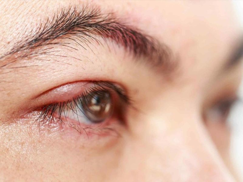 Cải thiện tình trạng mắt sưng khi ngủ dậy