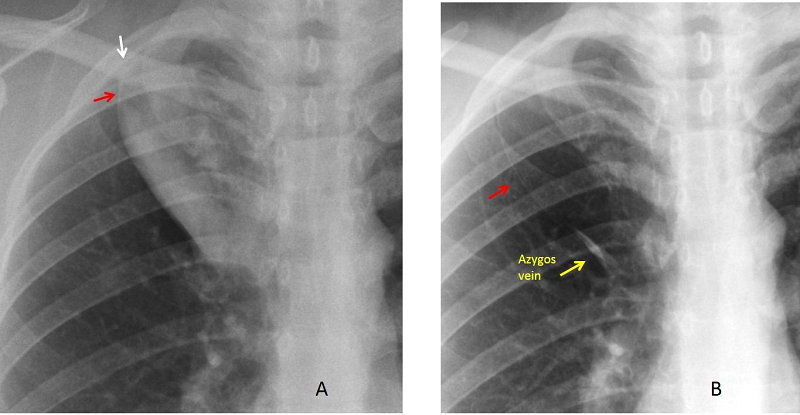 Hình ảnh chụp X-quang phổi