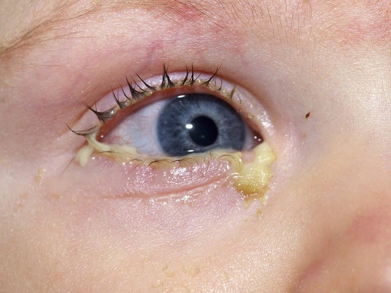 Trẻ bị đổ ghèn là do bụi bẩn và các chất gây dị ứng rơi vào mắt